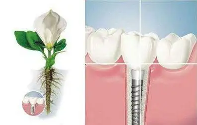 在廊坊,做种植牙如何提高成功率?|手术|口腔|牙科|种植体_网易订阅