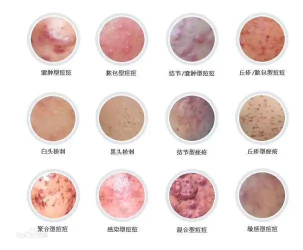 痤疮_皮肤病医院|皮肤病诊所|中牟县张杨贵皮肤科|博乐达超分子水杨酸