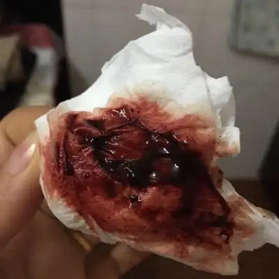 我老婆怀孕47天,昨天流了很多血,去医院检查是先兆流产,开了保胎药