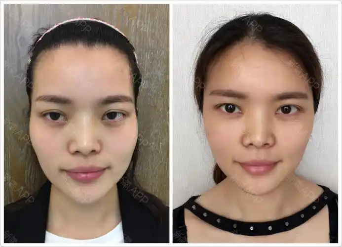 脂肪填充和玻尿酸比较那个更好,他们有什么区别呢?优缺点