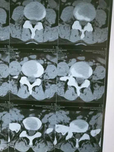 冠状位腰椎ct平扫.