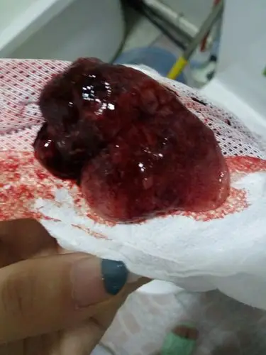 孕酮说让吃第一次吃四粒后面每八个小时吃一 怀孕一个多月,身上还有血