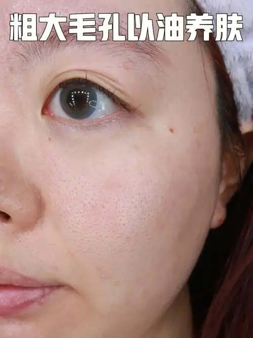 粗大毛孔自救跟着骆王宇以油养肤真的有效