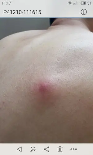 昨天晚上后背突然起个硬包类似于青春痘的疼