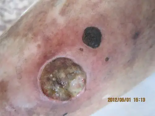 (有点恶心) - 皮肤及性传播疾病讨论版 - 爱爱医医学论坛 - 爱爱医