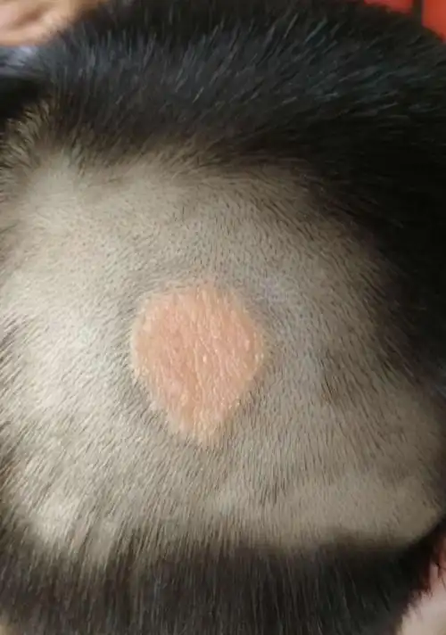 其它 头部色素痣手术 写美篇case2 枕部色素痣 case3 颞部疣状痣