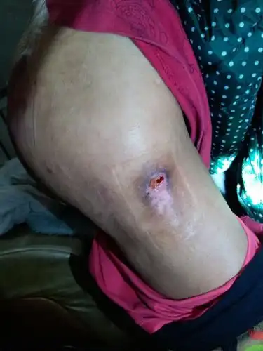 在外边看创面似乎不大,因为长期挤压,深层组织已经坏死,窦洞其实挺深