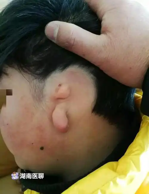 12岁少年天生没有"耳朵"!能圆耳朵梦吗?