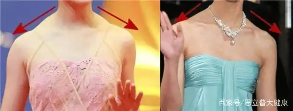 斜方肌发达不可逆?快停止斜方肌"锻炼"!