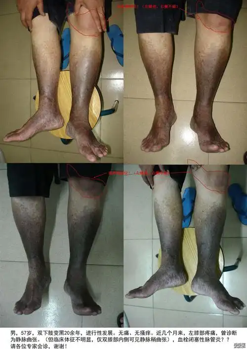 典型皮肤病会诊附图