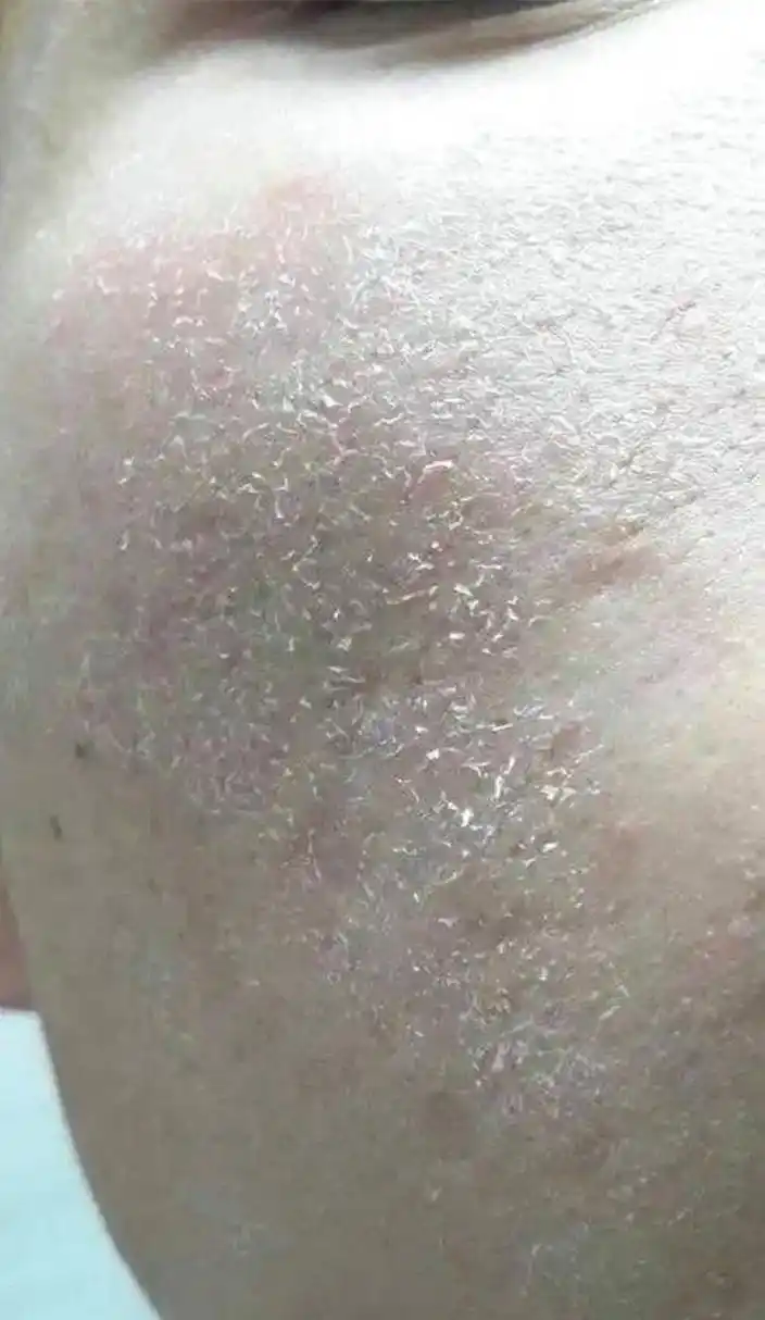 脸上皮肤起皮干燥有碎屑怎么办?