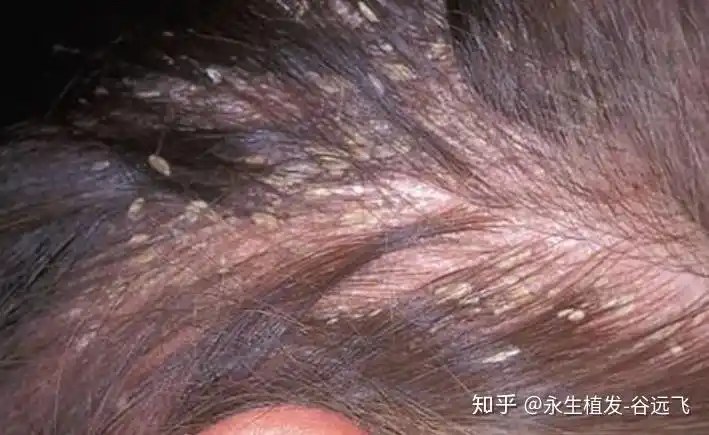 简单点来讲就是头皮上的一种容易造成脱发的微小生物.