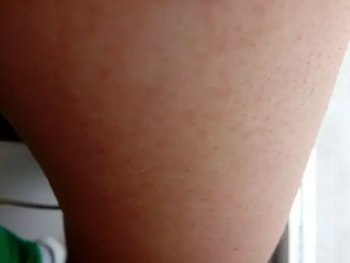 我的胳膊和大腿上面的汗毛孔好像堵塞了一样,已经7.