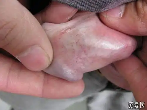 楼主江笋2011-05-26 17:53:07   男,26y,1年前行包皮手术,包皮瘀点2月