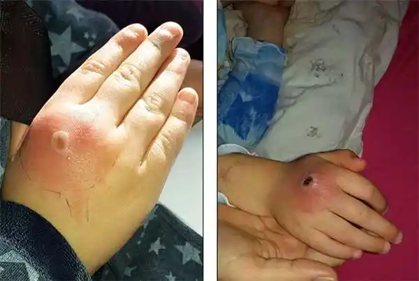 「致命蜘蛛」从天而降!女孩们被咬到轻则红肿,重则蜂窝性组织炎.