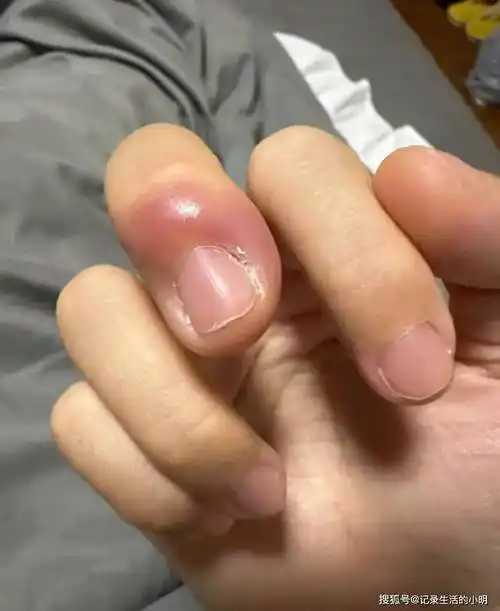 当事人警示:小心截肢风险!_手指_女士_治疗