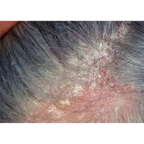 女性去头屑的洗发水