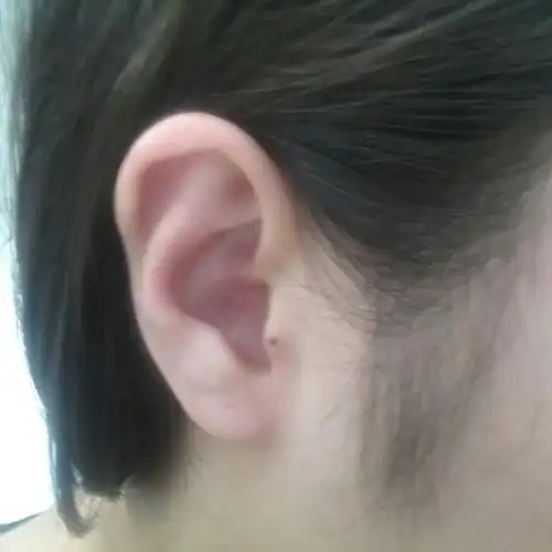 耳朵上有痣,怎么解?