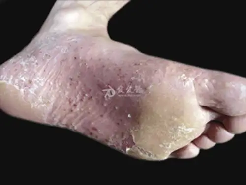 孕妇疥疮初期腹部皮肤症状图片