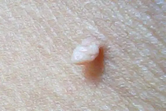 长个小肉揪怎么回事 疣是什么样子图片-问吧