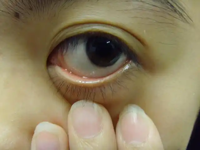 我的眼睑处长了一个白色的小泡(具体请见图