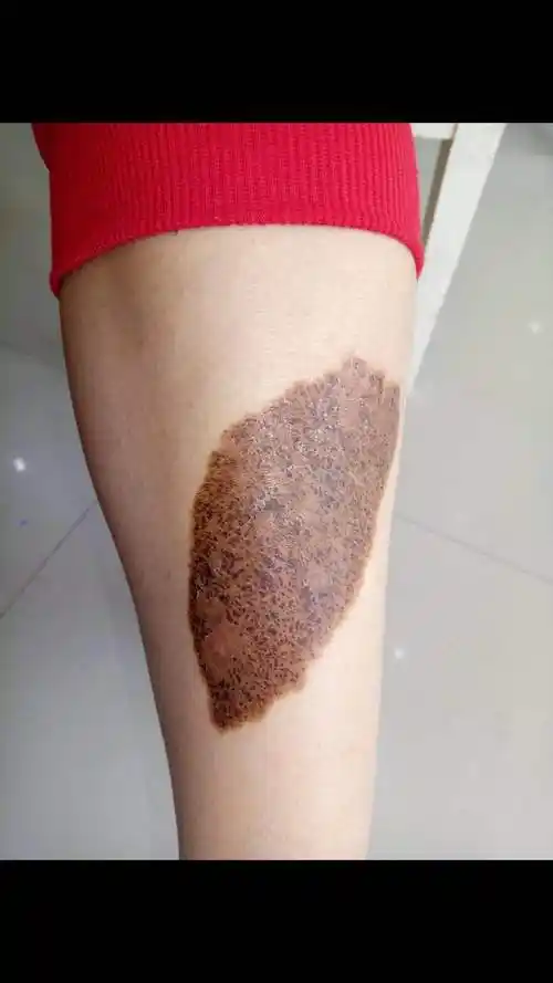 郸城的想问下咖啡斑去除后还会不会复发在治疗期间需要注意什