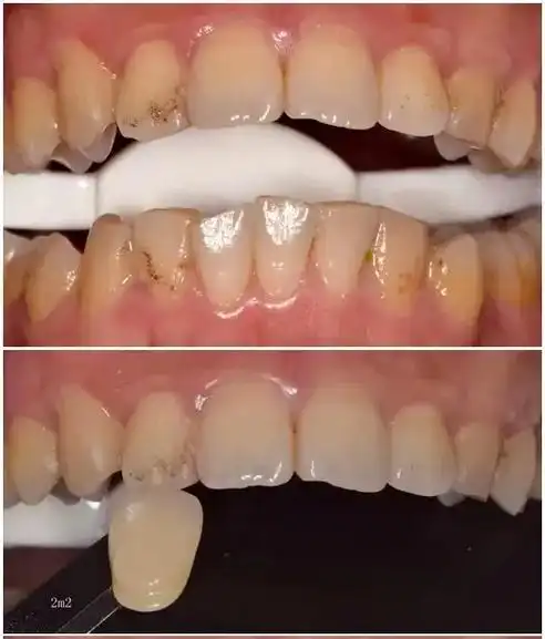 冷光美白对比图#努力工作,快乐生活 #服务我们是认真的 #希 - 抖音