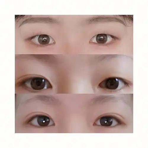 单眼皮变双眼皮