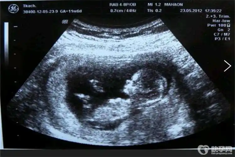 孕期四维彩超怎么看男女5个方法快来对应看看是儿是女