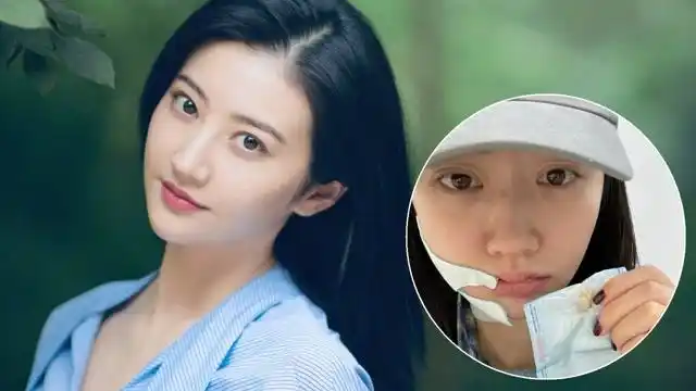 景甜拔智齿后首露面,右脸肿成包子气色憔悴,脱妆后鼻梁疤痕明显