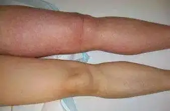双下肢不对称,左腿肿胀并有皮色改变