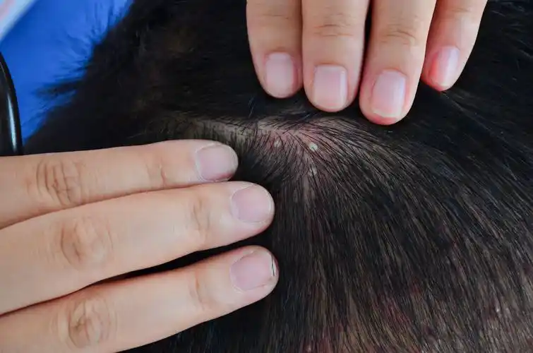 头皮干货|油屑敏感星人,到底应该如何自救? - 知乎