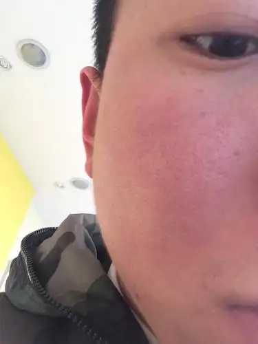 我是男生,我脸上的毛孔特别大,有人说我脸上像马蜂窝一样,请问我应该