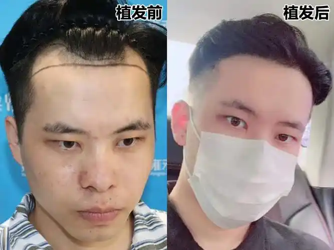 秃额角,发际线 高,适合什么发型? - 知乎