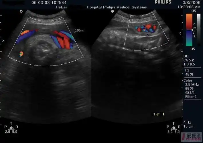 脐带绕颈三周. - 超声医学讨论版 - 爱爱医医学论坛