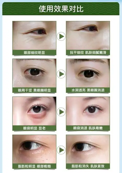 【7天去除黑眼圈】去眼袋qu脂肪粒/细纹干纹鱼尾纹/美目精油10ml