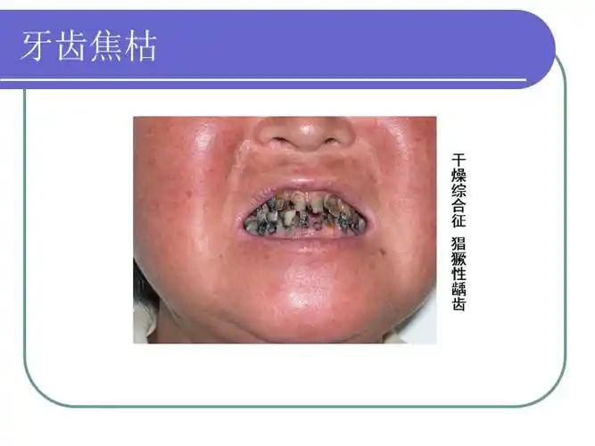 干燥综合征简介