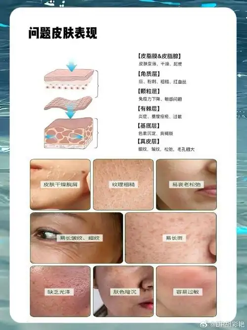 #护肤##黄金微针##痘痘##痤疮##皮肤美容##保养##疤痕