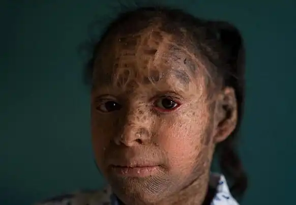 印13岁"蛇女"患鱼鳞病无法外出过正常生活