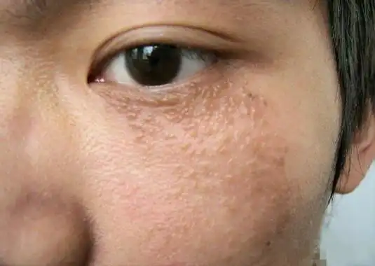 扁平疣怎么治疗才有效?阜阳皮肤病医院治疗扁平疣效果怎么样?