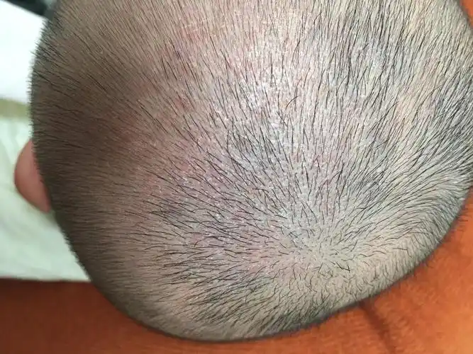 宝宝4个月10天出生十几天后头上一直有白色类似于头皮屑状皮