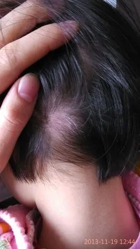 孩子头后面一团白发怎么回事如图