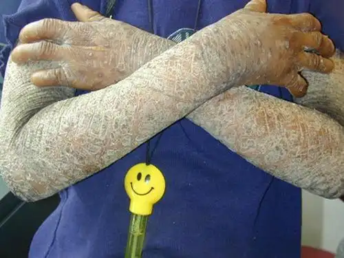 鱼鳞皮肤怎么治最有效