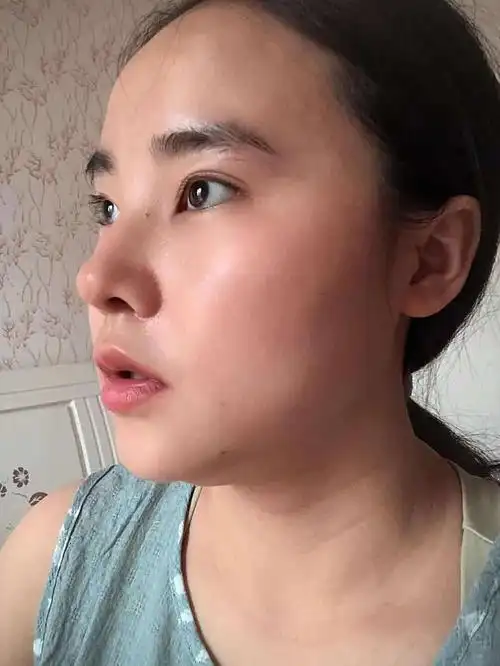 术前诊断这位女性朋友自身的鼻子比较扁平,短鼻,没有_圈子-新氧美容
