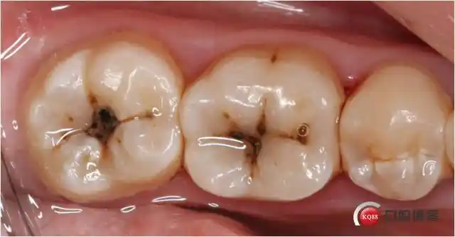 龋齿的那些修复事