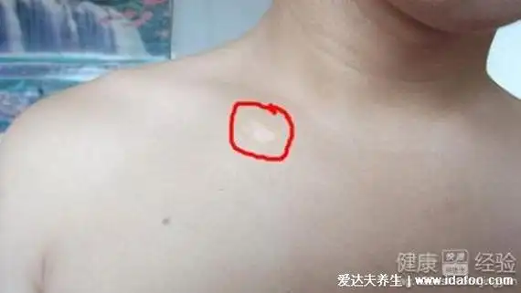 最真实白斑图片初期症状图片,白斑刚开始会瘙痒