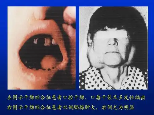 干燥综合征讲课正式稿ppt