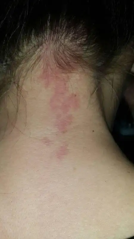 脖子后面出现的红斑是怎么回事?求解答