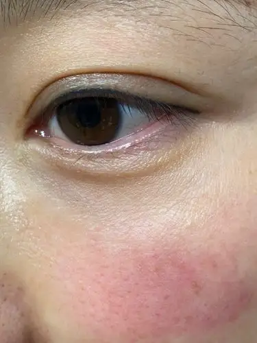 本想做全脸和眼睛,脸部角质层很薄,红,最后只做了眼_圈子-新氧美容