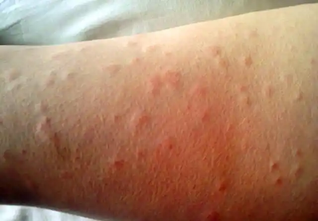 湿疹和湿气重是什么原因?